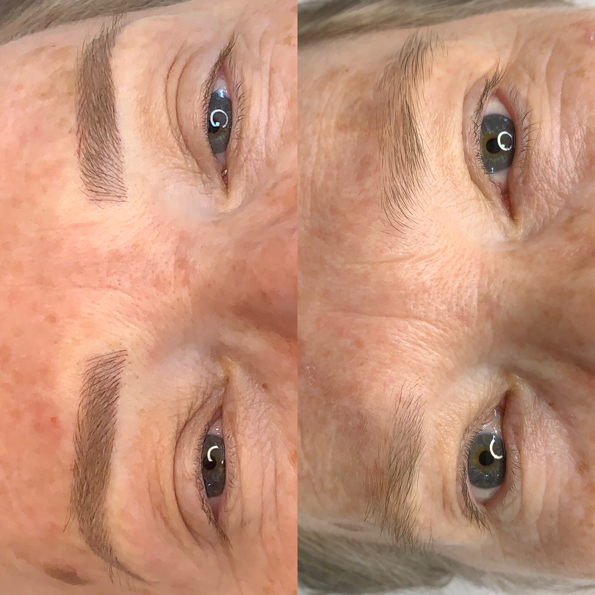 Resultado de remoção a laser